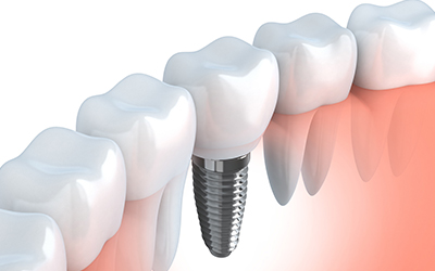 Dental Implant