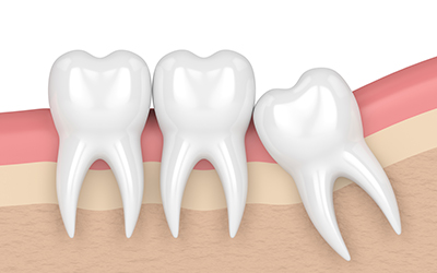 Impacted wisdom tooth