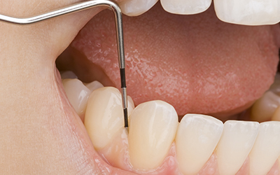 A dentist measuring a patients gums