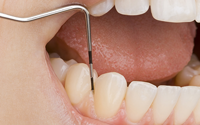 An up-close of a patients dental gums