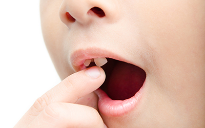 child with loose tooth