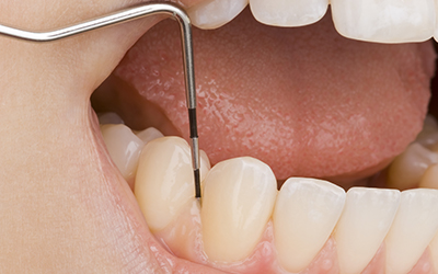 Checking a patient gum recession