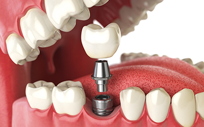 Tooth dental implant
