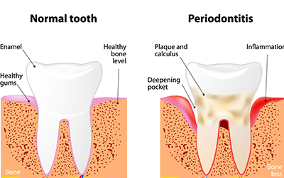 Stages of caries development
