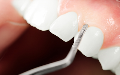 Gums of a patient being examined closely