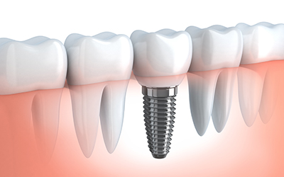 Dental implant