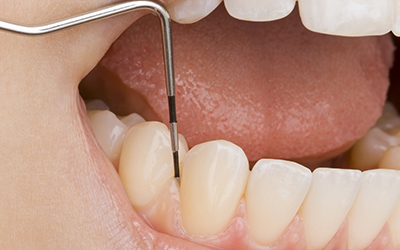 Dentist measuring the gums on a patient